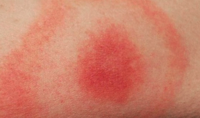 Science of Lyme Disease